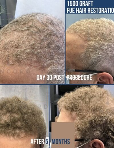 1500 graft FUE hair restoration