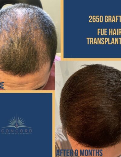 2650 graft fue hair transplant