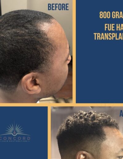 African American hair transplant