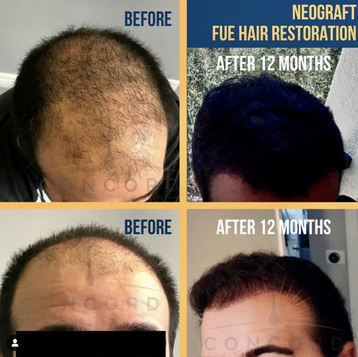 FUE hair restoration after 12 months
