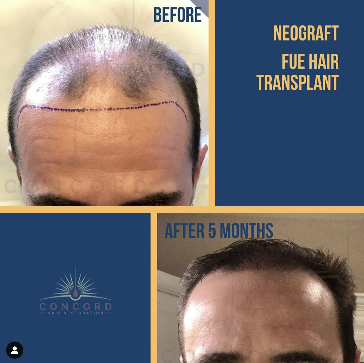 Los Angeles hair transplant