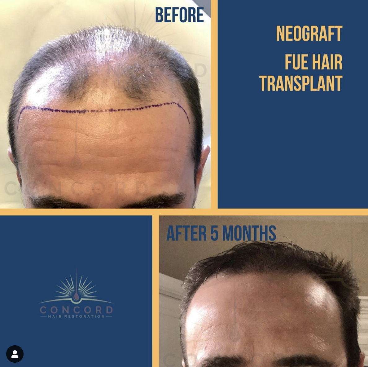 5000 grafts hair transplant cost usa