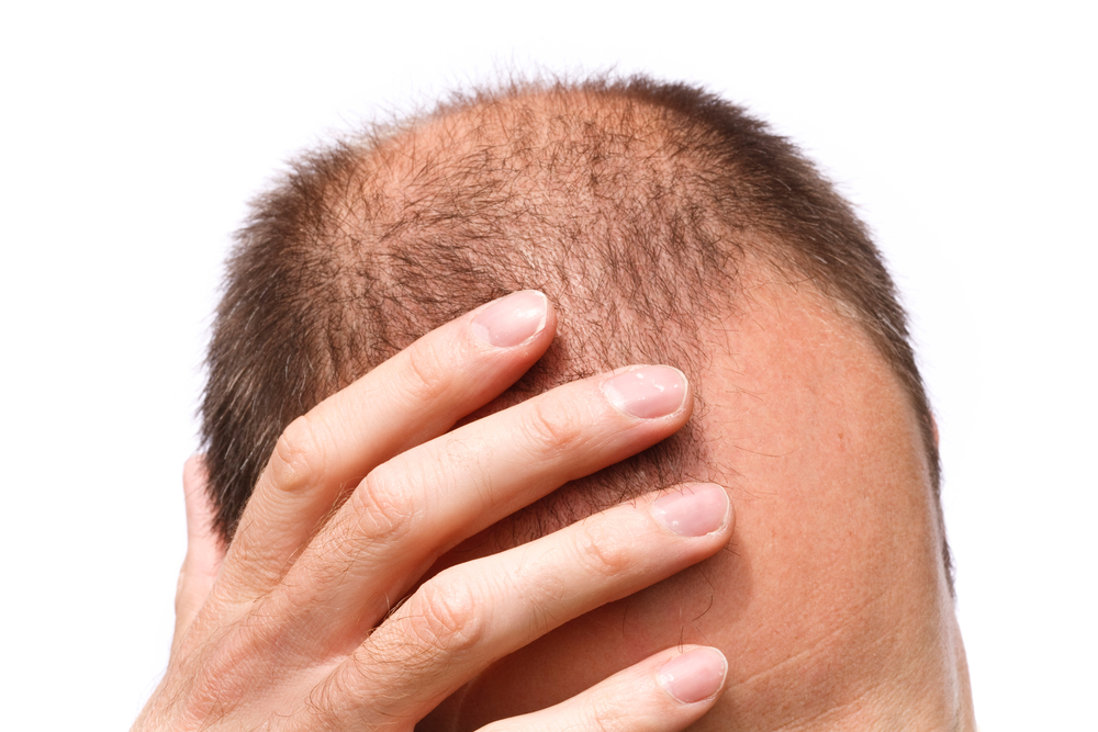 Is Male Baldness an Early Sign of Prostate Enlargement BPH?