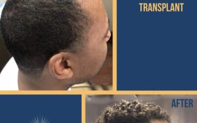 Men’s African American Hair Transplant