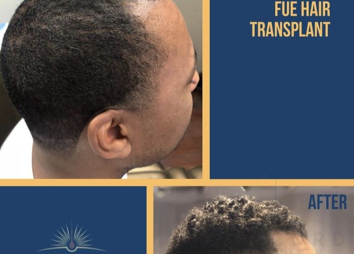 Men’s African American Hair Transplant Men’s Afro-American Hair Transplant Services