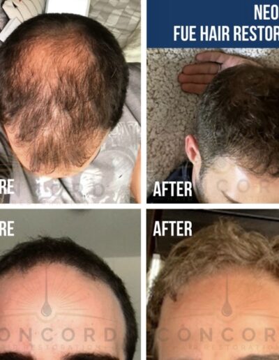 Neograft FUE hair restoration