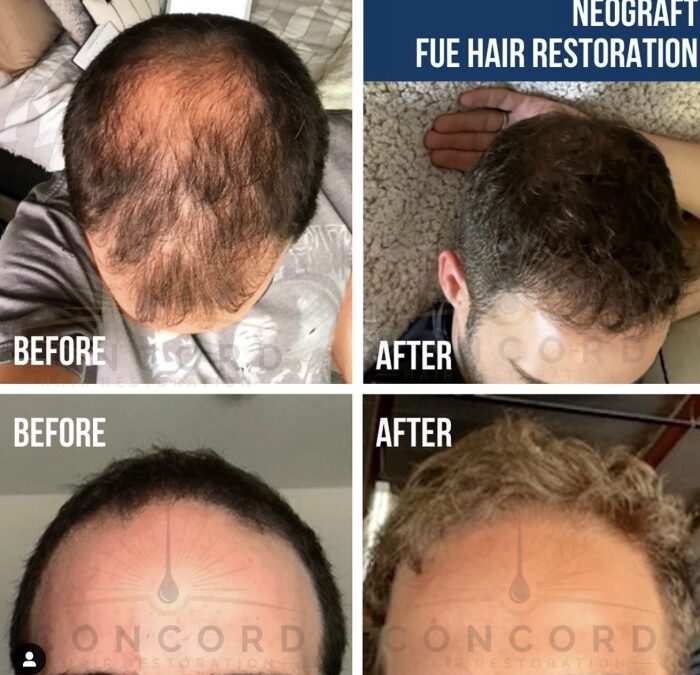 Hair restoration