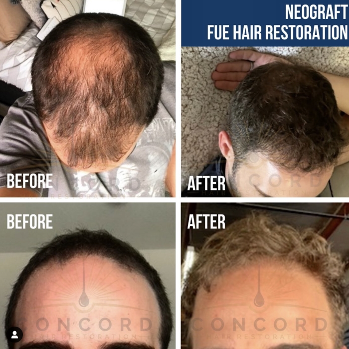 Neograft FUE hair restoration