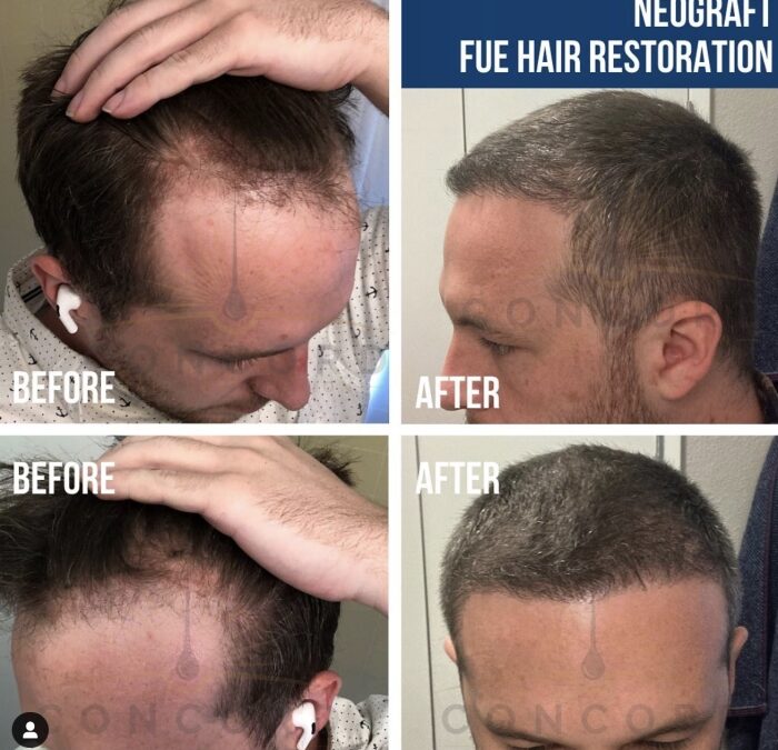The best hair restoration
