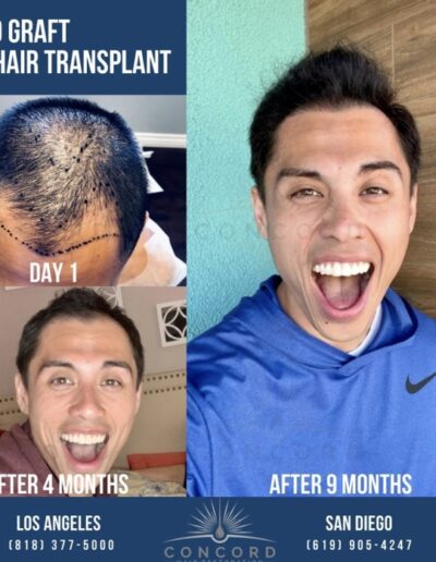 amazing before and after hair transplant