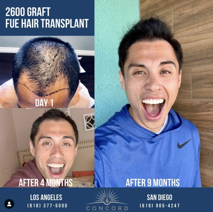 amazing before and after hair transplant