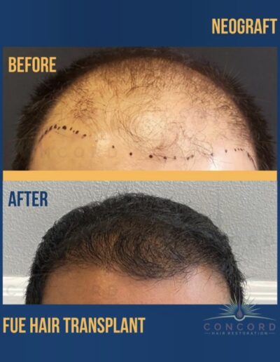 amazing hair transplant before and after