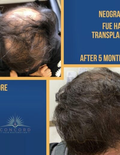best hair transplant before after