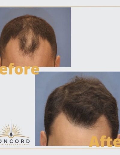 fron hairline balding restored