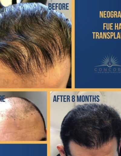 hair restoration before after photo
