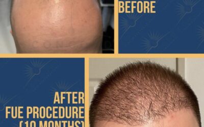 Hair Loss Treatment That Works With Minimal Healing Time