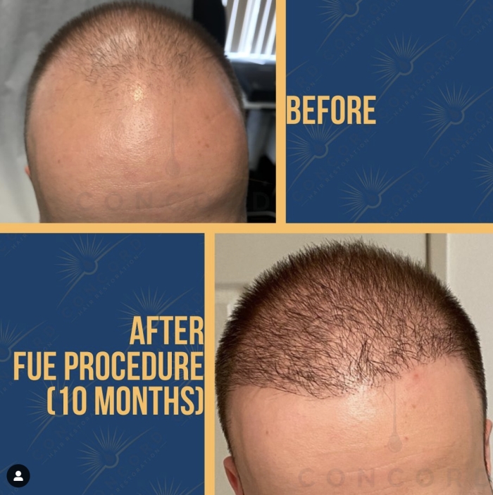 hair restoration before and after San Diego