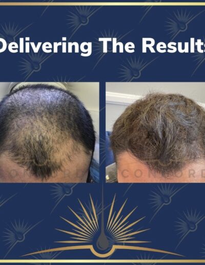 hair restoration before after photo