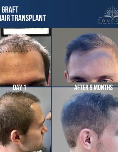 hair transplant 3200 graft