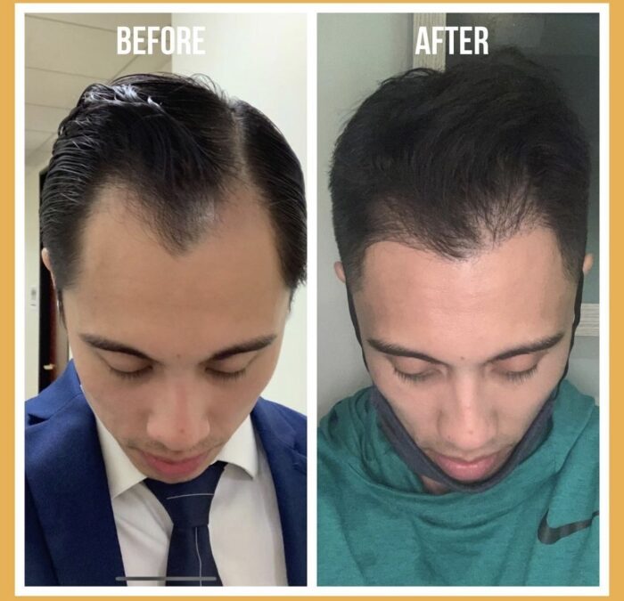 Hairline restoration