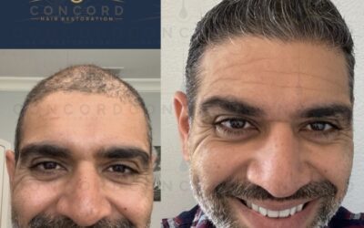 The Best Hair Transplant in Los Angeles is at Concord Hair Restoration
