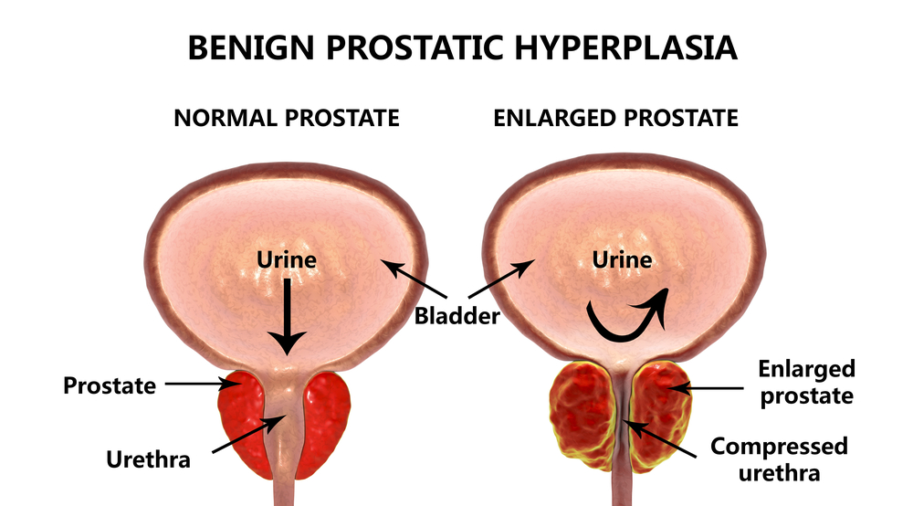 Benign prostatic hyperplasia, 3D illustration showing normal and enlarged prostate gland
