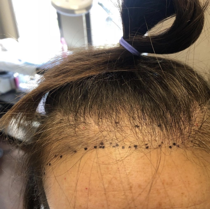 female hair transplant