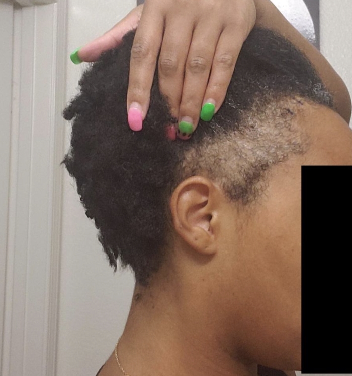 African American woman hair transplant