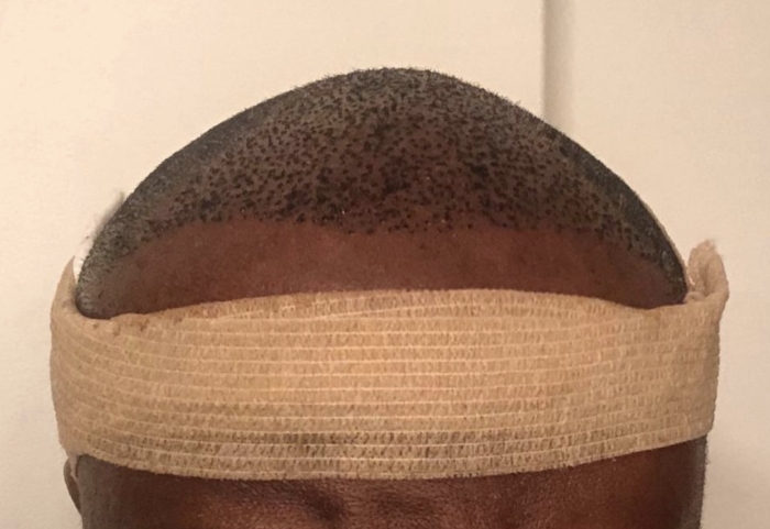 After just 3 days and his hairline looks great. FUE Hair transplants have a quick recovery time and no scarring! Contact us today to schedule a consultation!
