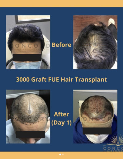 hair transplant Los Angeles