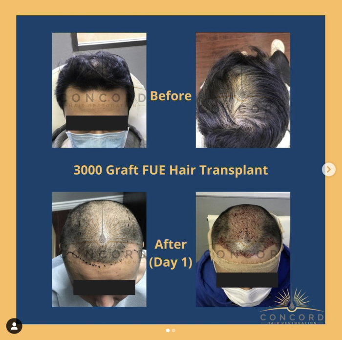 hair transplant Los Angeles