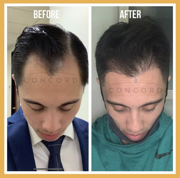 hairline restoration