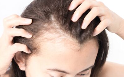 Reasons a FUE Hair Transplant is Right for You