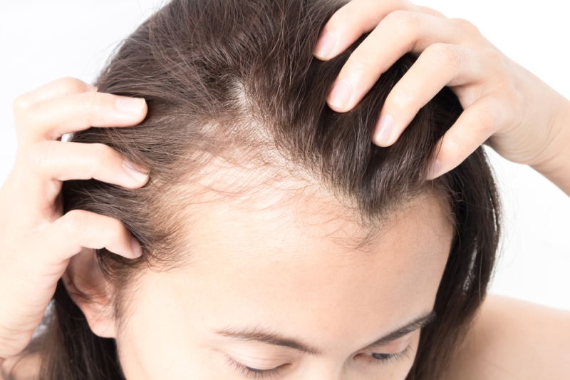 Reasons a FUE Hair Transplant is Right for You