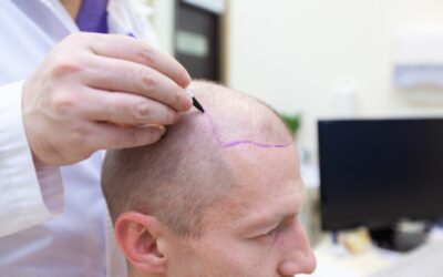 3 Common Mistakes to Avoid When Choosing a Hair Loss Specialist