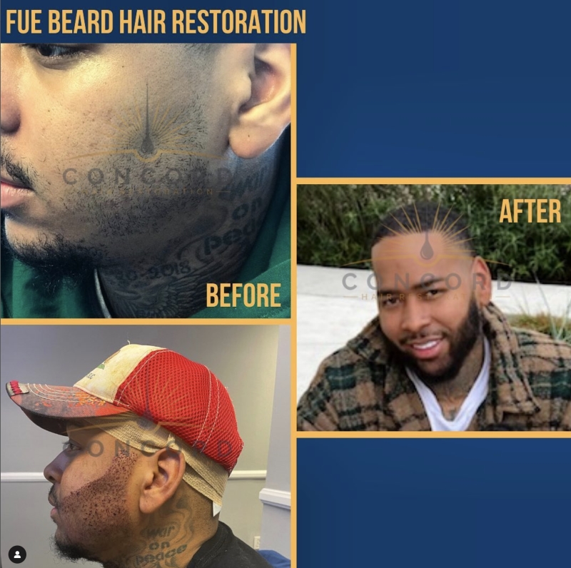 FUE beard restoration