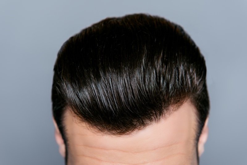 Hair Loss Treatment That Works With Minimal Healing Time