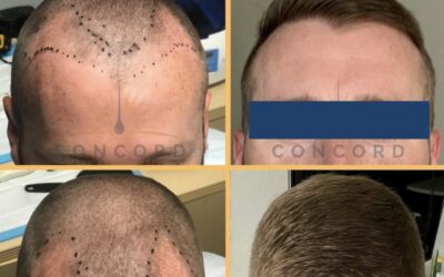 Hair transplant timeline