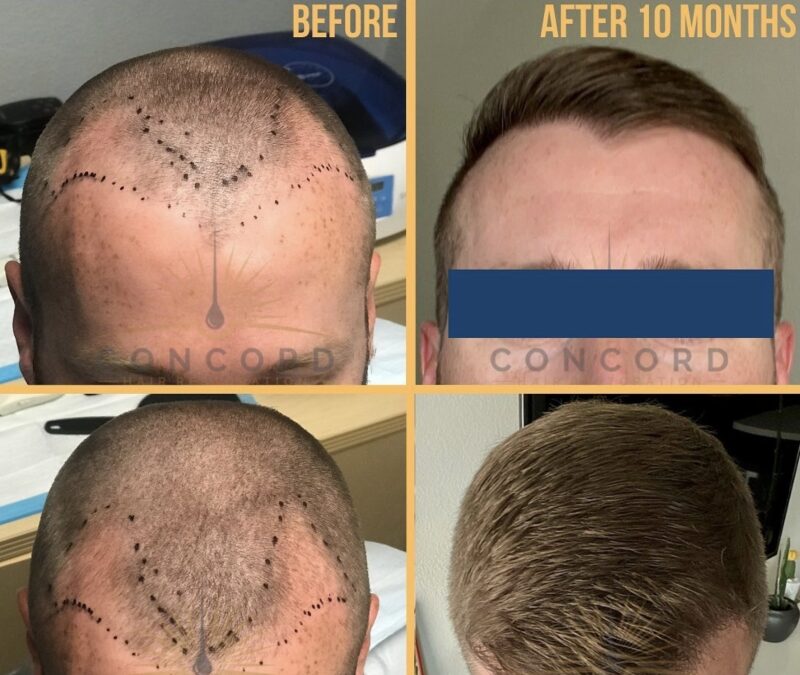 FUE hair transplant before and after 1