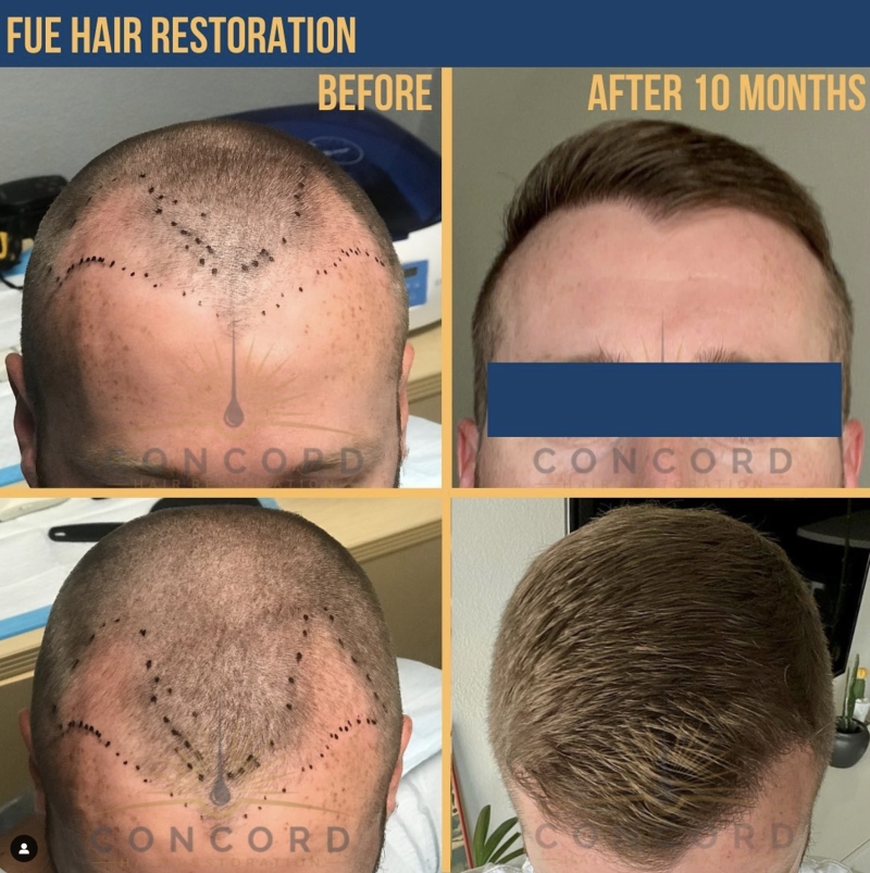 FUE hair transplant before and after 1