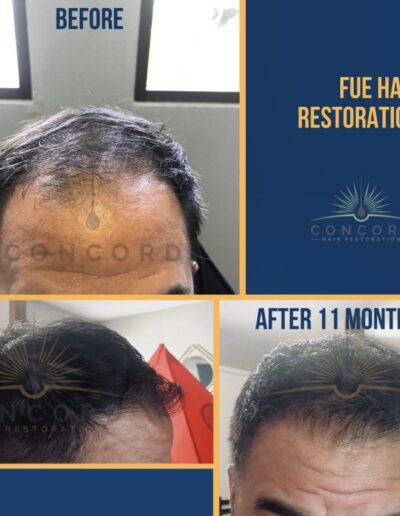 FUE hair transplant before and after 2