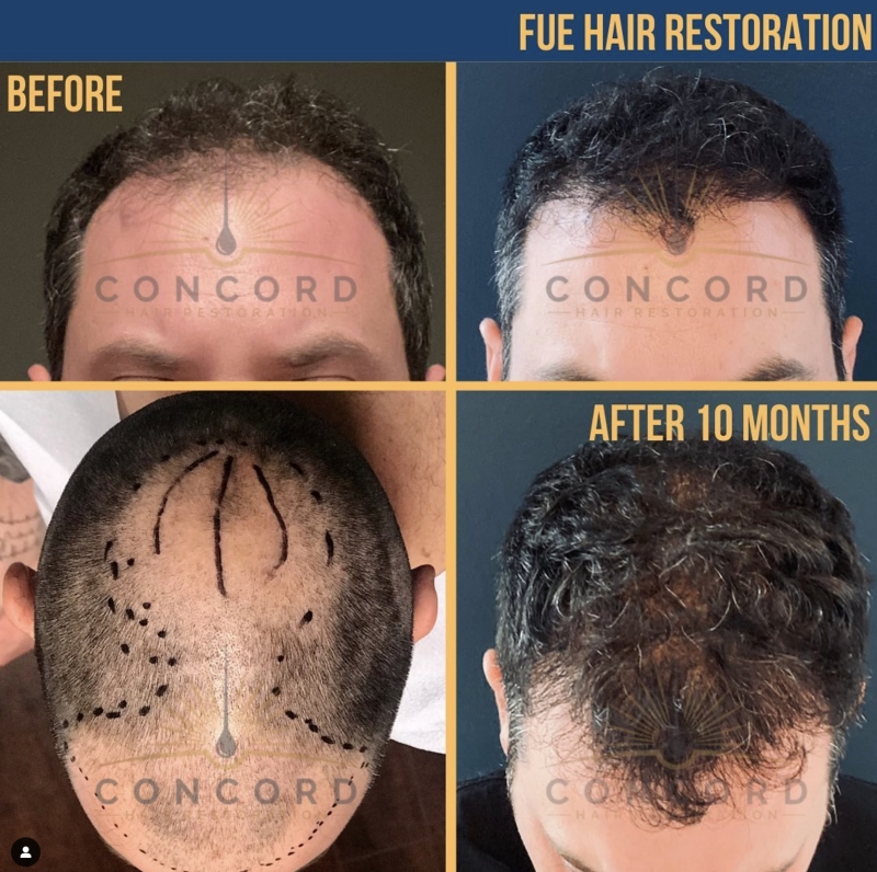 FUE hair transplant near me