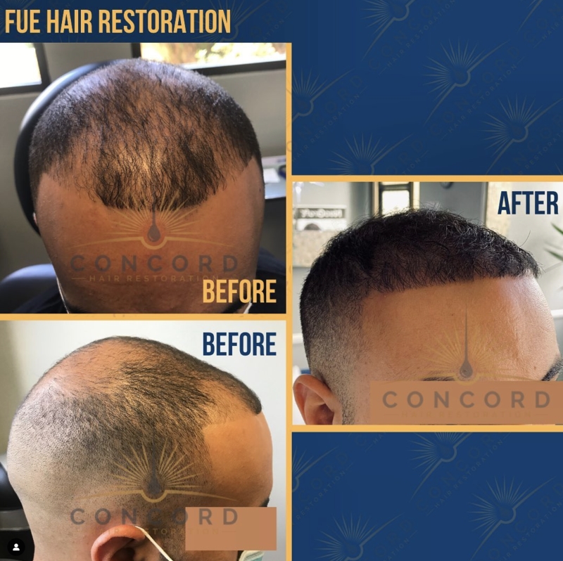 Hair transplant near me