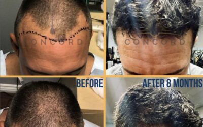 Why Fue Hair Transplants Are Widely Preferred