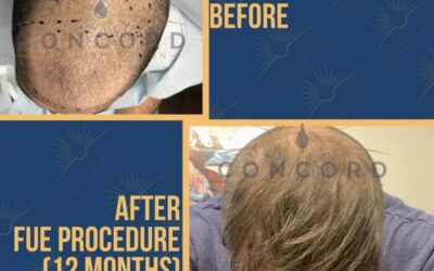 Hair transplant for density