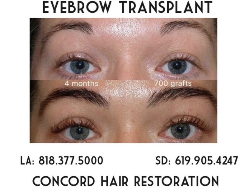 eyebrow hair transplant in San Diego and Los Angeles