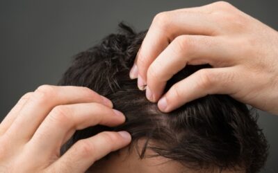 Can Hair Loss Occur After Weight Loss?