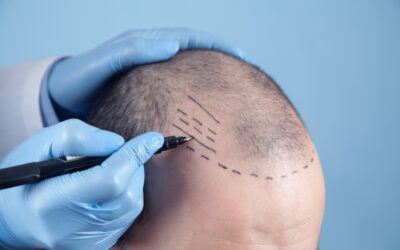 What To Expect After A FUE Transplant