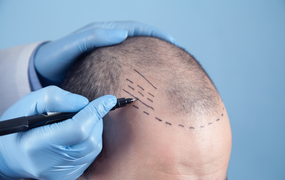 What to Expect After a FUE Transplant