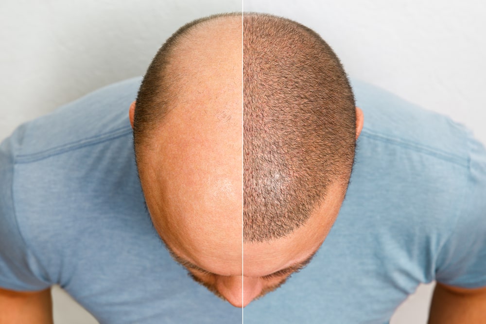 How Much Does a Hair Transplant Cost In LA? Concord Hair Restoration